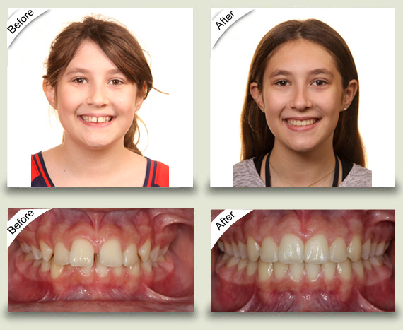 Actual Patients of Pearson Orthodontics